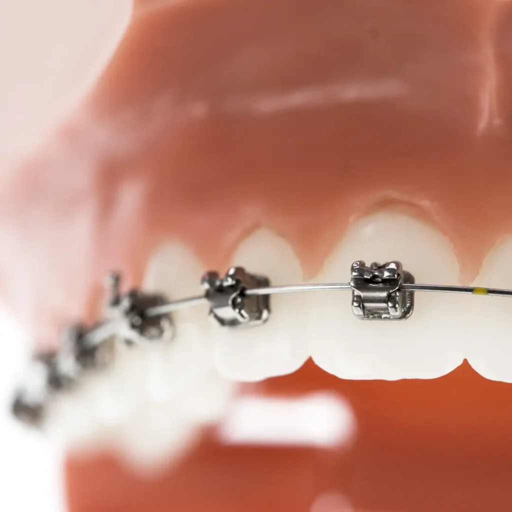 Optimizando el Tratamiento Ortodóncico Secuencia de Arcos en Ortodoncia