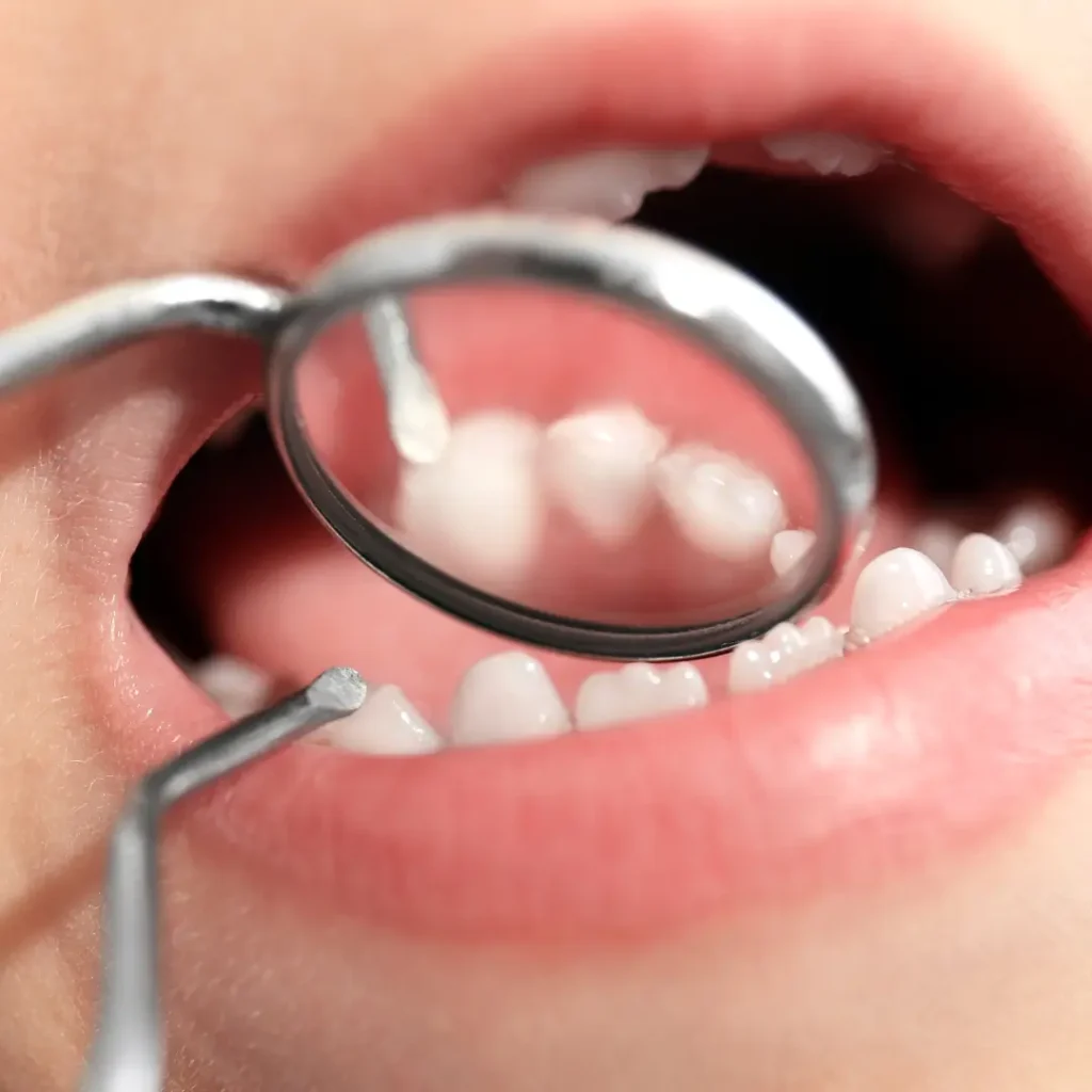 Terapia Pulpar en Odontopediatría