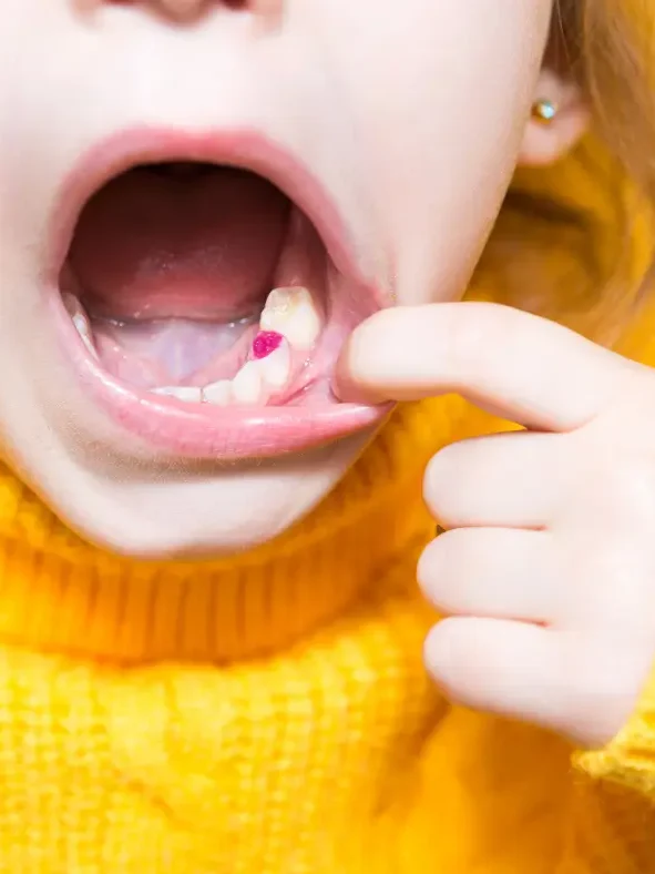 Extracciones seriadas