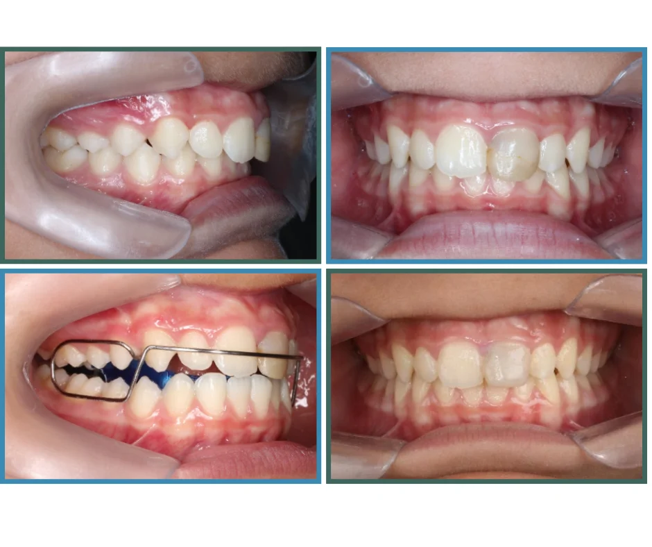 tratamiento bionator