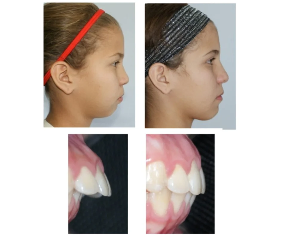 tratamiento bionator