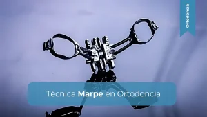 Miniatura Técnica Marpe en Ortodoncia