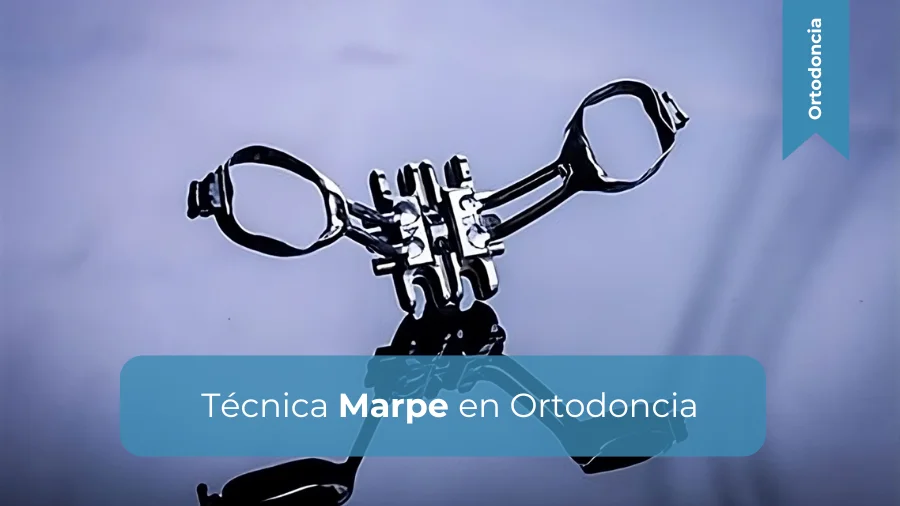 Miniatura Técnica Marpe en Ortodoncia