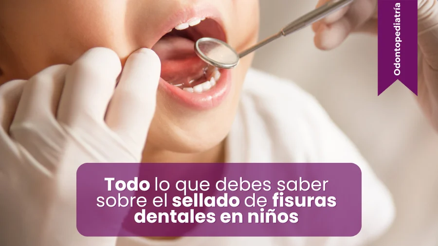 Todo-lo-que-debes-saber-sobre-el-sellado-de-fisuras-dentales-en-nino