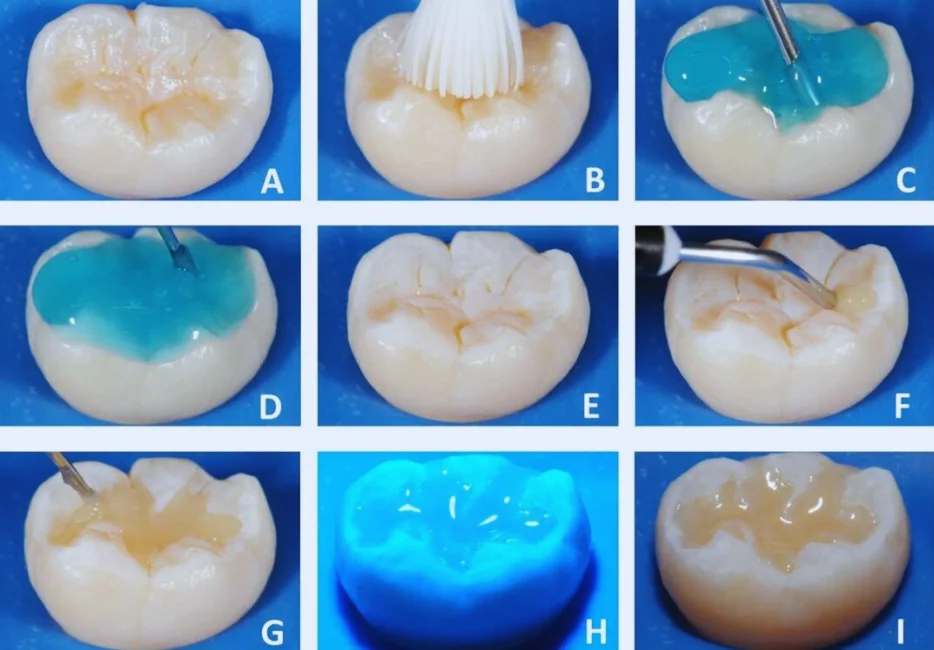 fosetas y fisuras dentales