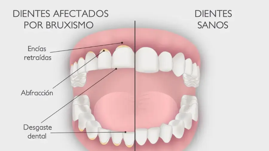 Bruxismo y Maloclusión